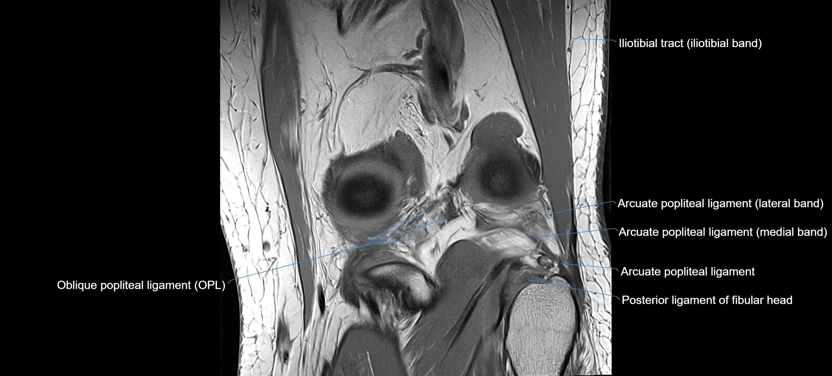 MRI coronal  ligaments cross sectional anatomy 3T  radiology  image-img-04001-00029.webp
